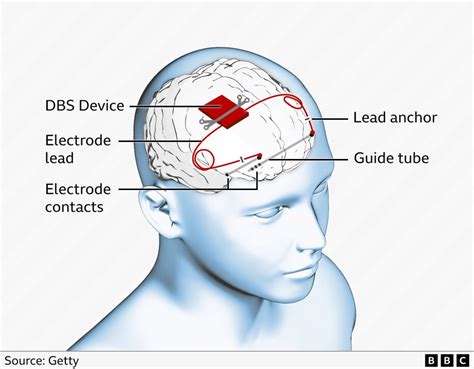 best neurosurgeon in asia|World first epilepsy device fitted in UK boy's skull .